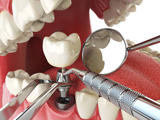 Best Emergency Root Canal Treatment in Temperance, MI