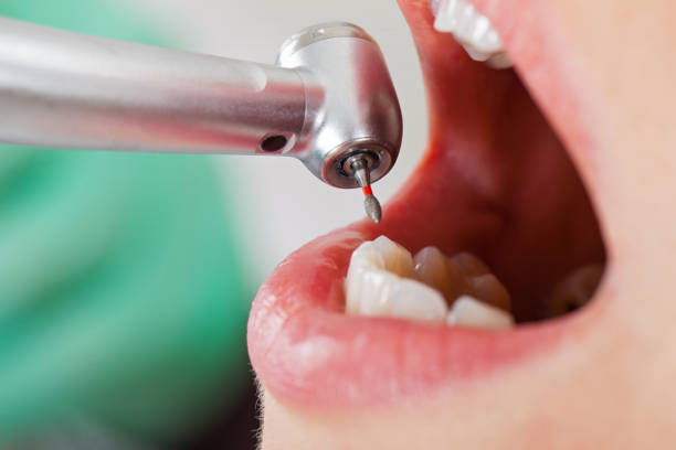Best Emergency Wisdom Teeth Removal in Temperance, MI